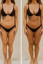 Before and after SJOLIE Original N°12 Dark spray tan on a woman in a black bikini