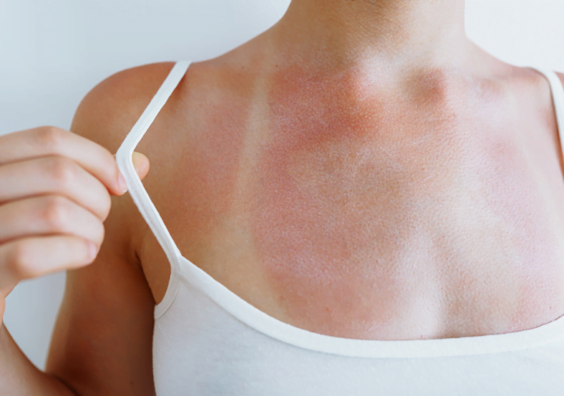 Spray tanning sunburns — Sjolie