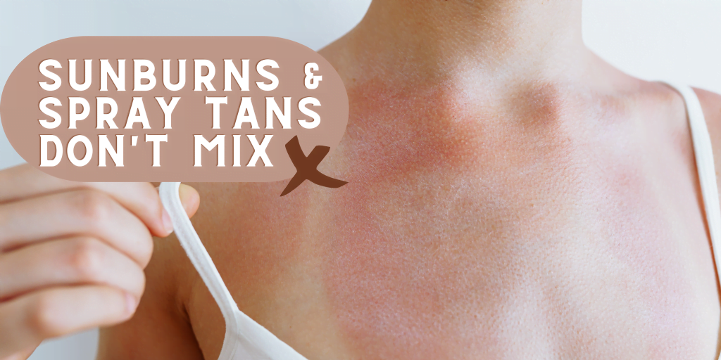 Spray tanning sunburns — Sjolie