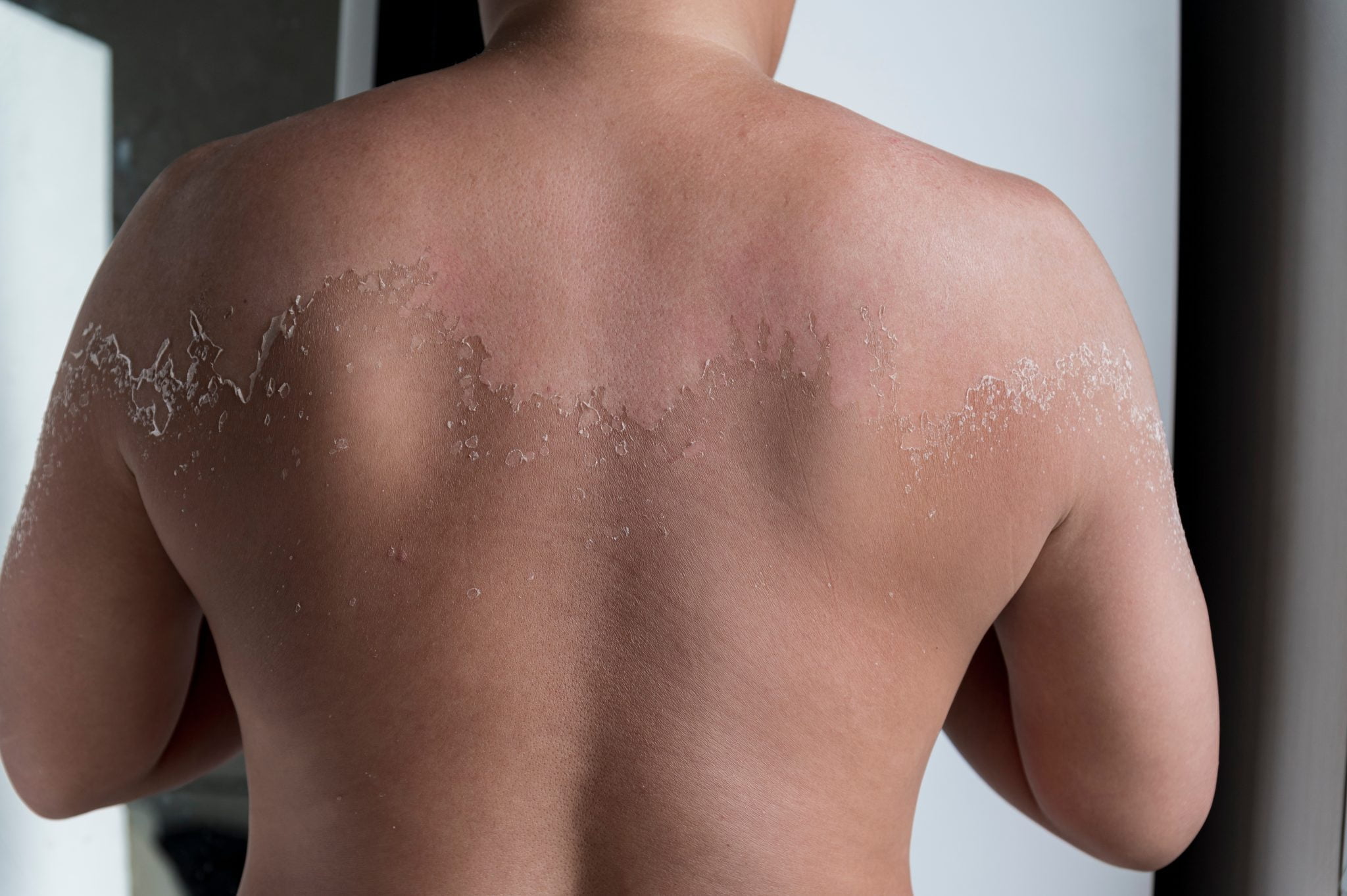 Spray tanning sunburns — Sjolie